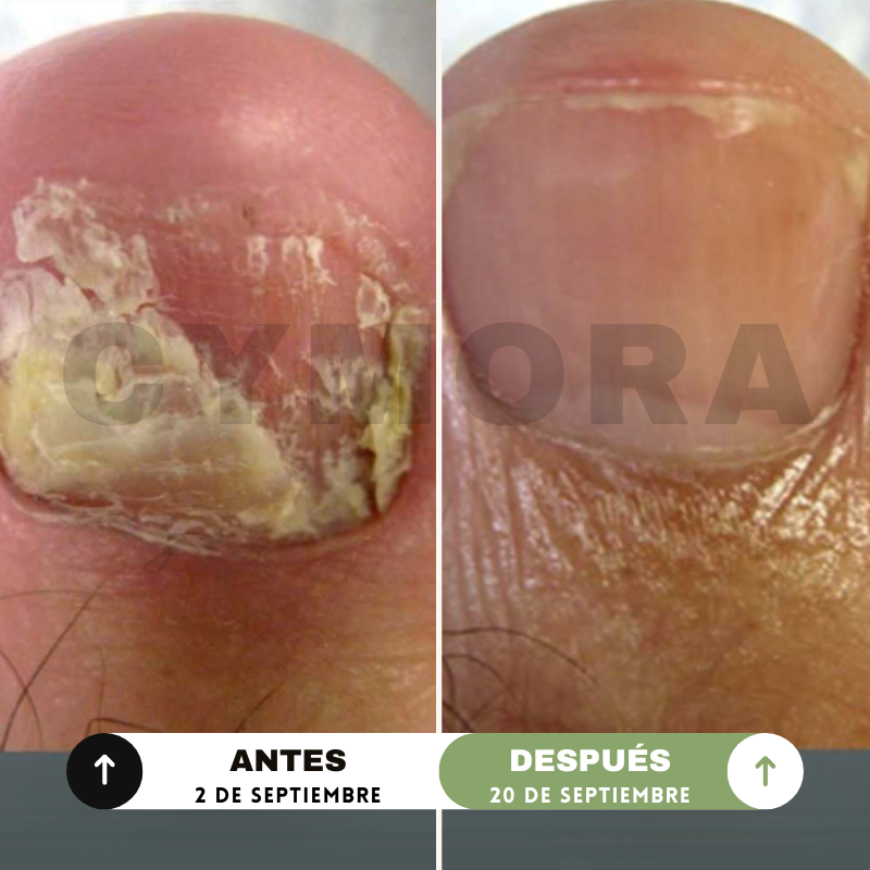 Cymora™ ToeArmor Serum 4