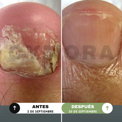 Cymora™ ToeArmor Serum 4